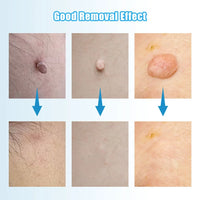 Auto Skin Tag Removal Tool Kit Painless Skin Label Mole Acne Wart Removal Pen with Cleansing Swabs Facial Skin Care Beauty Tool
