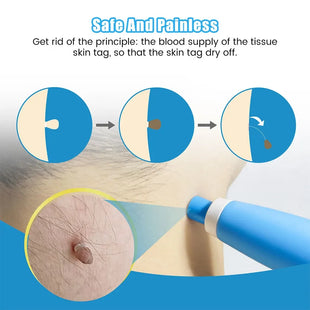 Auto Skin Tag Removal Tool Kit Painless Skin Label Mole Acne Wart Removal Pen with Cleansing Swabs Facial Skin Care Beauty Tool